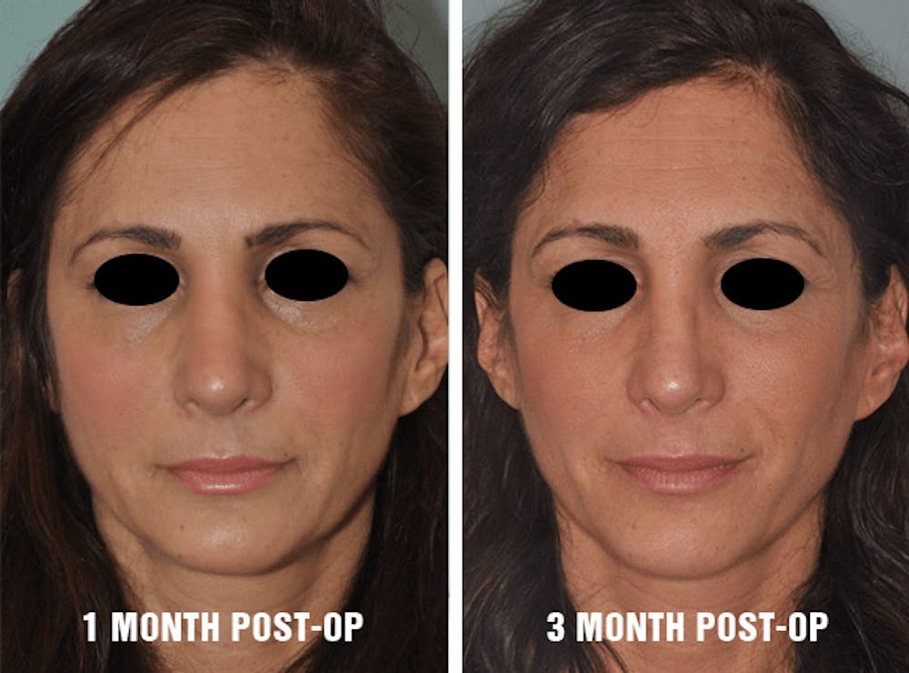Rhinoplasty swelling results at 1 and 3 months Post-operative results at one and three months