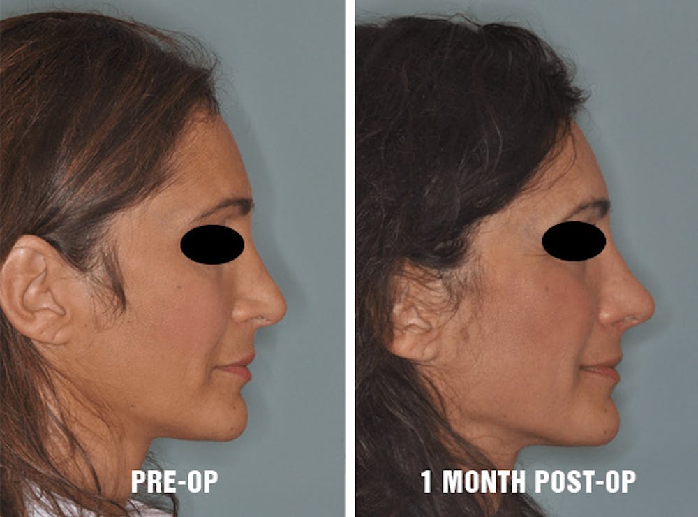 Pre and post-operative results (Right) Pre and post-operative results before and three months after (Right)