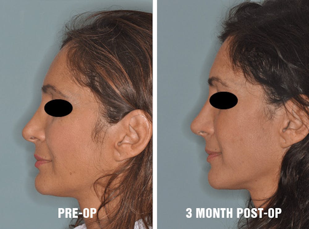 Pre and post-operative results before and three months after (Left)