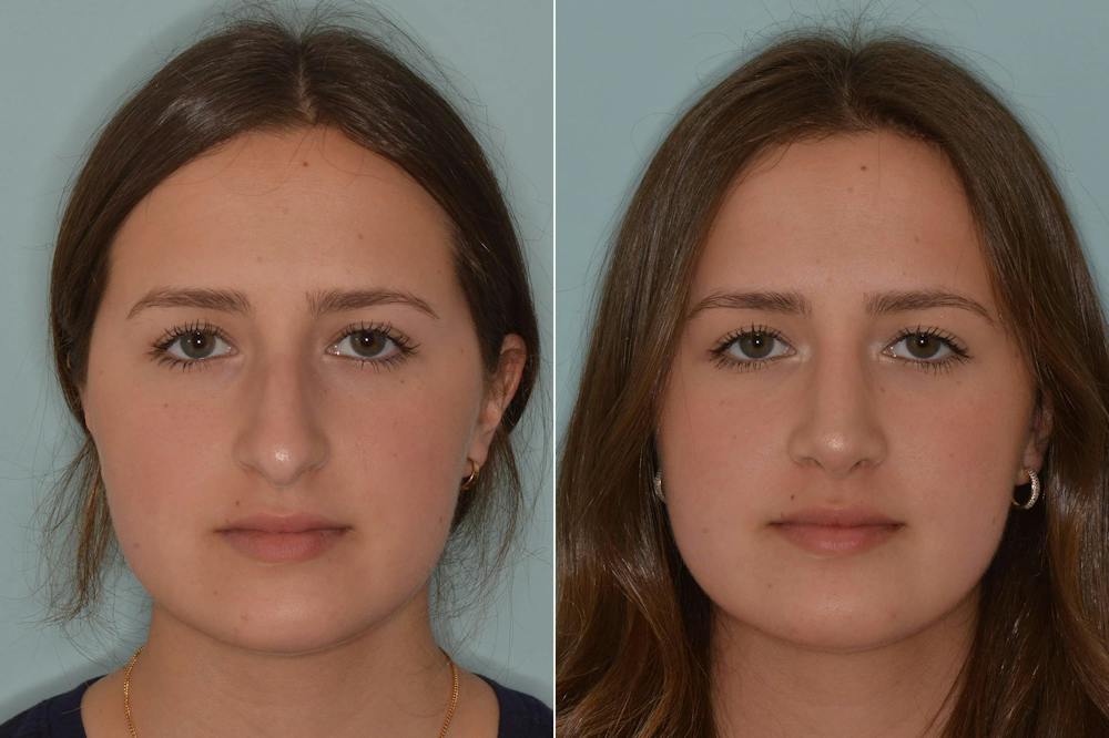 Rhinoplasty Before and After Photos in Miami, FL, Patient 4633