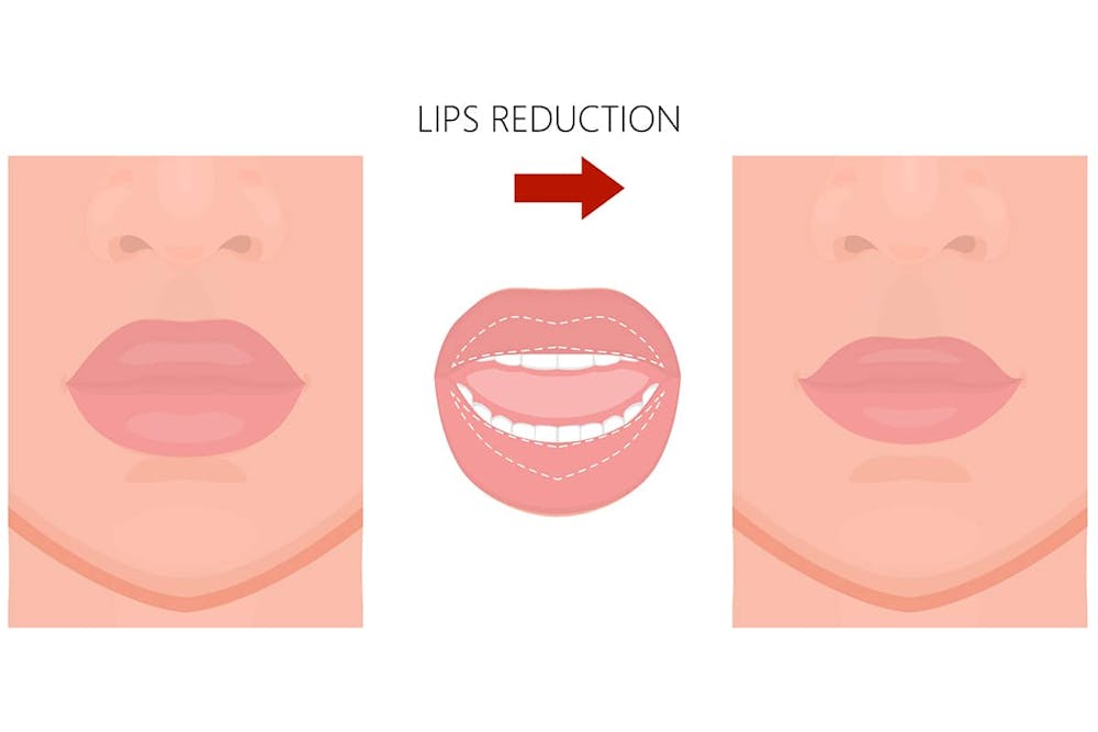 Cheiloplasty is a facial surgery designed to reduce the size and volume of overly large lips by removing tissue from the inner area of the lips