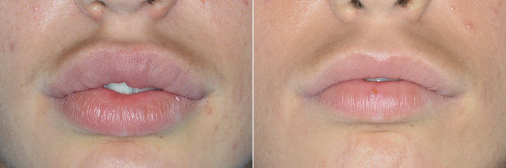 Cheiloplasty: Specialized Lip Reduction for Overly Large Lips, Before and After Photos Lip Reduction Before and After Photos in Miami, FL, Patient 4043