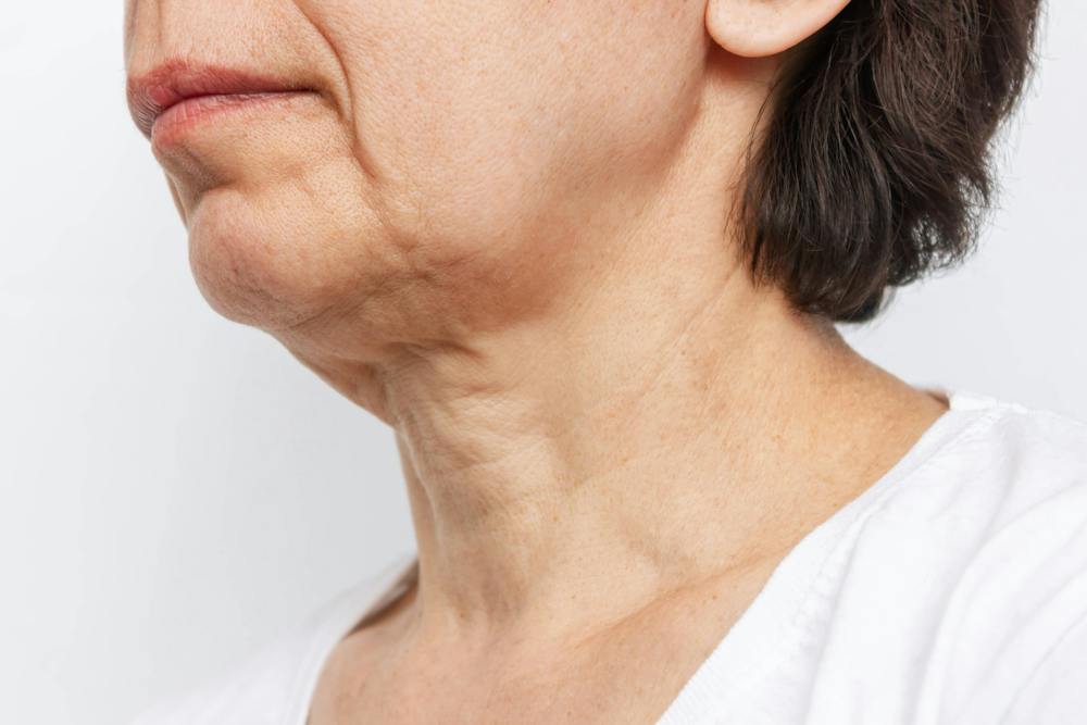  Sagging neck is a common condition in older people due to loss of skin elasticity