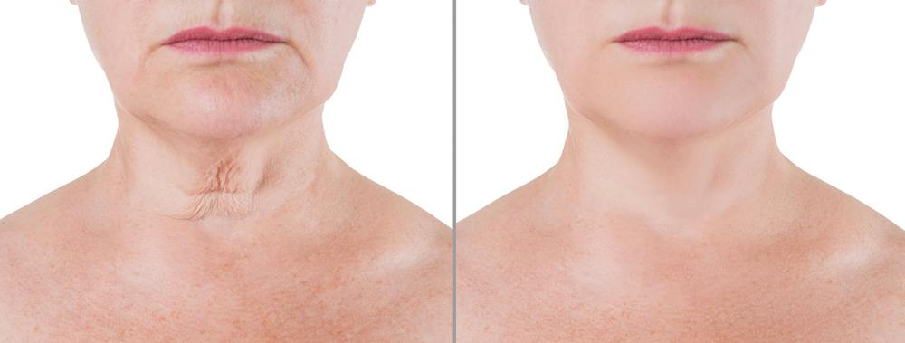 Miami patient's before and after neck lift results