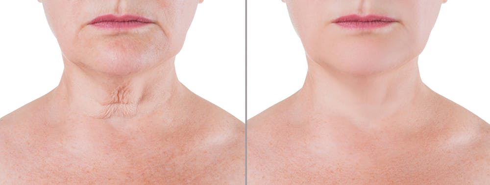 Miami patient's before and after neck lift results