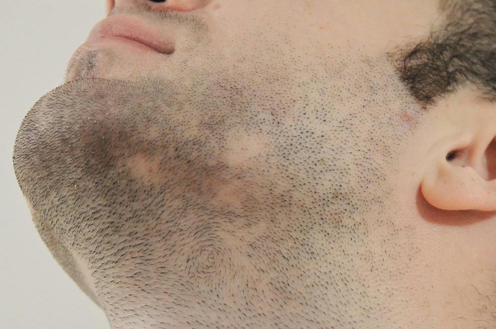 Beard implants growing after surgery