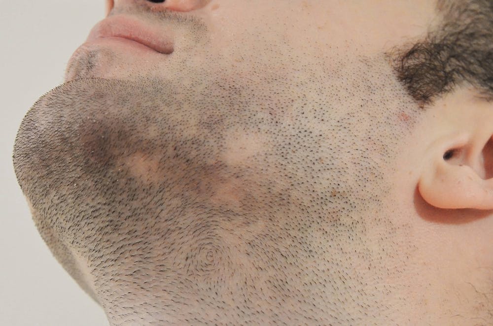 Beard implants growing after surgery