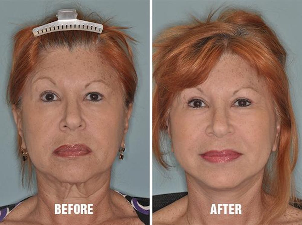 Necklift Before and After Photos in Miami, FL, Patient 2534