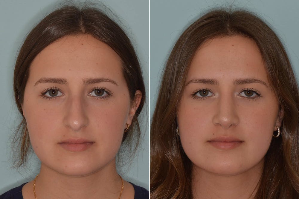 What to Eat Before and After Rhinoplasty Surgery, Before and After Photos Rhinoplasty Before and After Photos in Miami, FL, Patient 4633