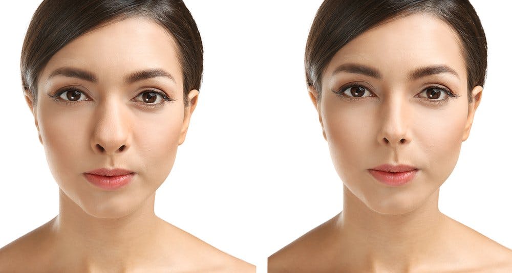 Dr. Bared can balance your looks with his vast experience at Hispanic rhinoplasty in Miami, FL.