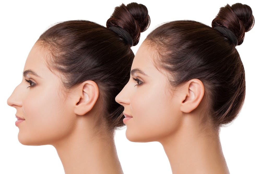 Make yourself look balanced with a revision rhinoplasty in Miami, FL with Dr. Anthony Bared.