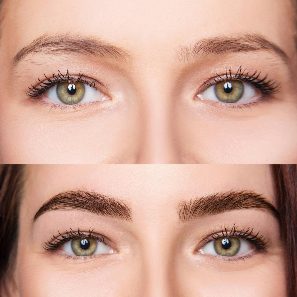Consult with an expert facial plastic surgeon, Dr. Bared provides gold-standard eyebrow transplant in Miami