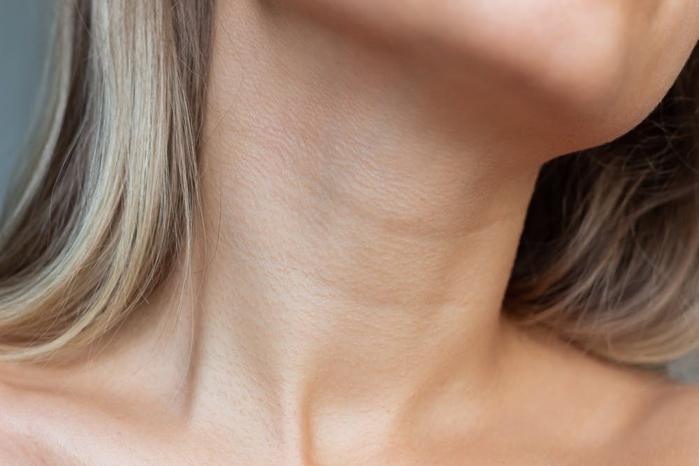 Dr. Bared explains how scars appear on the skin after a neckllift and how they could appear. Always consult with an expert and what is the best treatment option for you.