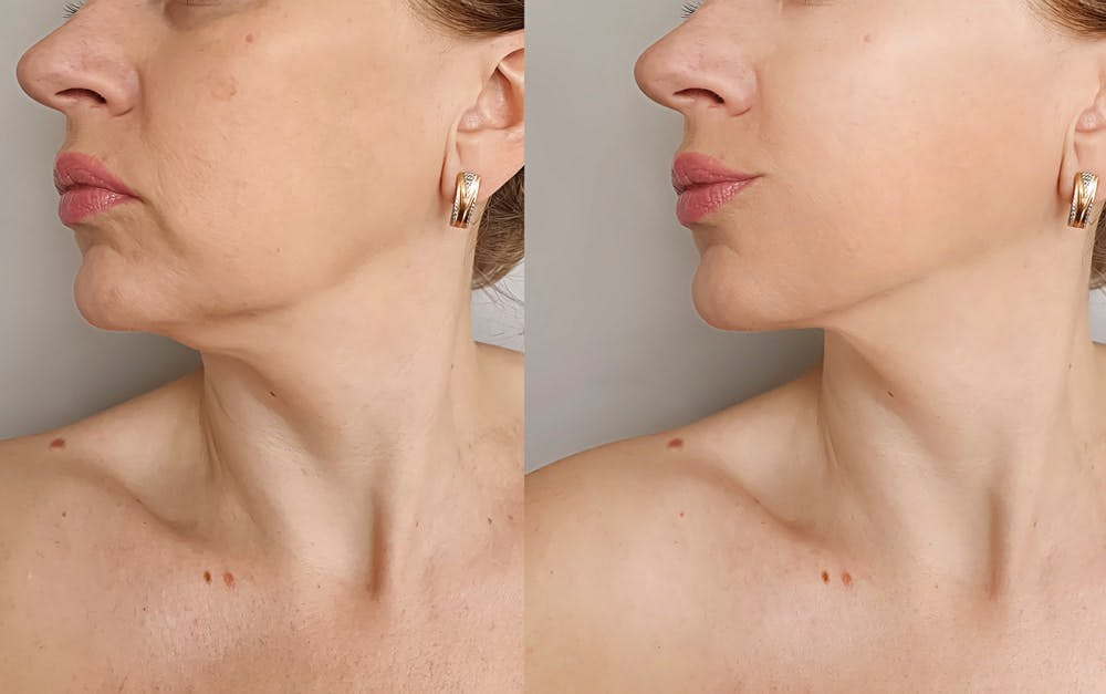 Follow your surgeon guidance and detailed tips for great management of scar appearance after a Neck Lift Surgery at Miami,FL.
