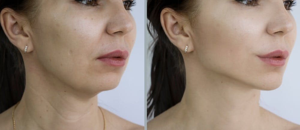 Dr. Bared provides tips on scar mangement after a neck lift surgery