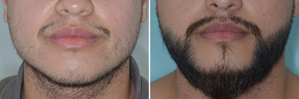 Beard Transplant Before and After Photos in Miami, FL, Patient 6723