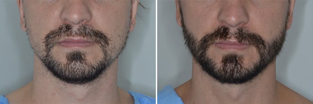 Beard Transplant Before and After Photos in Miami, FL, Patient 6956