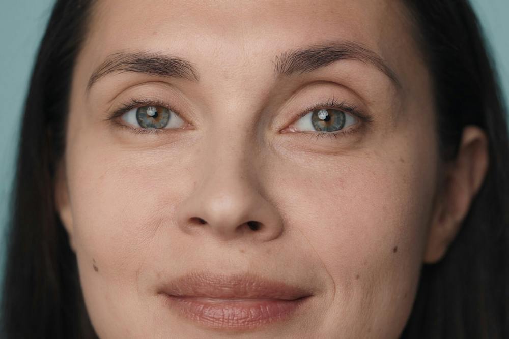 Close-up of a woman's face highlighting areas treated with Botox