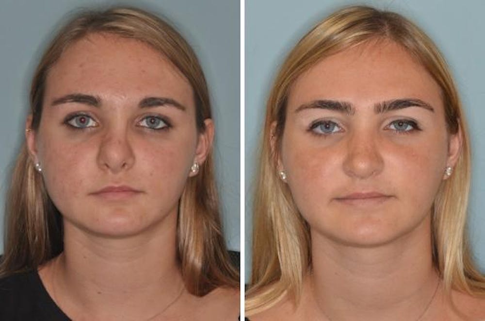 Revision Rhinoplasty Before and After Photos in Miami, FL, Patient 900