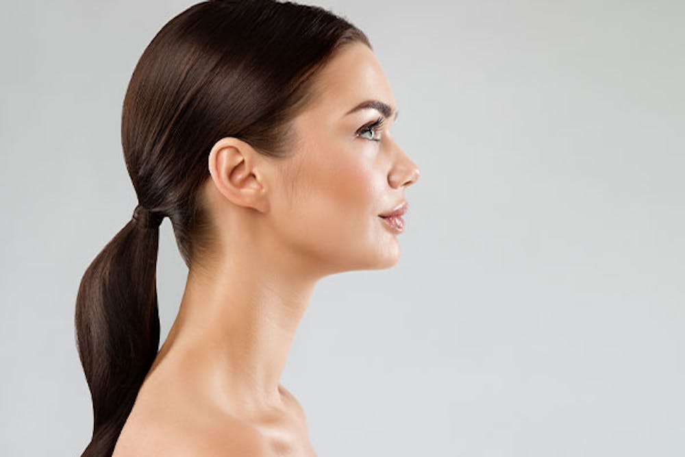 woman after her closed rhinoplasty in Miami, FL