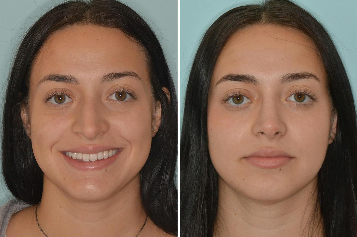 Rhinoplasty Before & After Gallery - Patient 240512 - Image 3