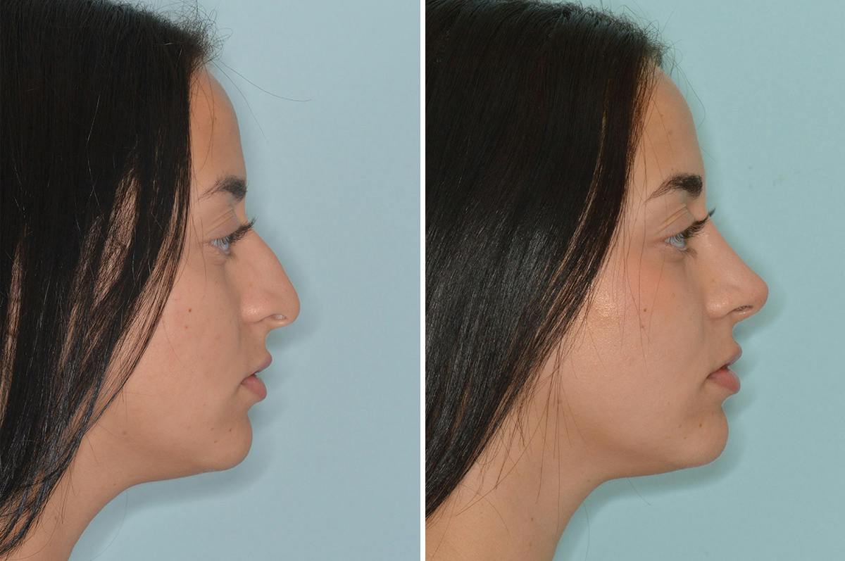 Rhinoplasty Before & After Gallery - Patient 240512 - Image 1
