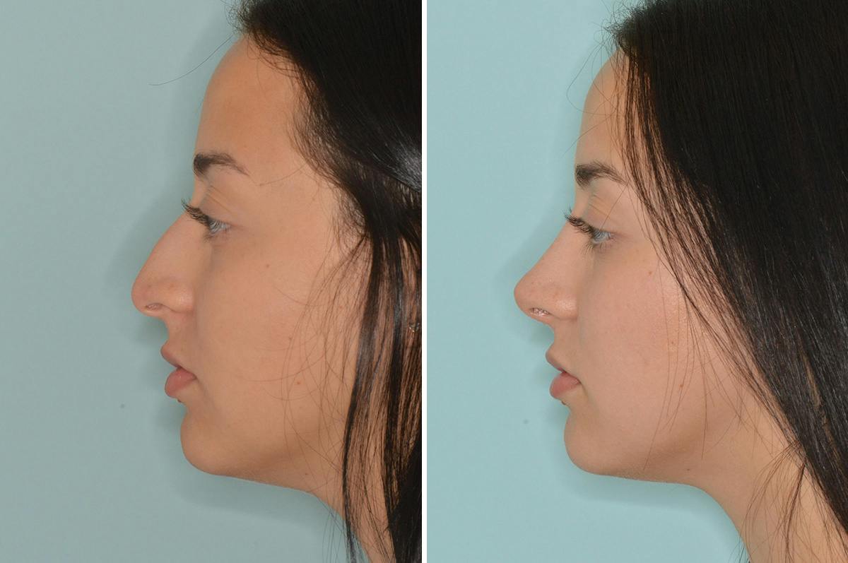 Rhinoplasty Before & After Gallery - Patient 240512 - Image 2