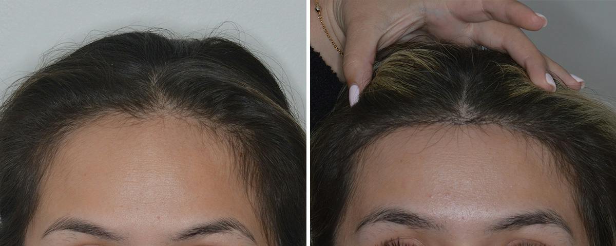 Hair Transplant Before & After Gallery - Patient 816121 - Image 1