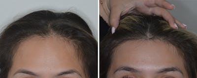 Hair Transplant Before & After Gallery - Patient 816121 - Image 1