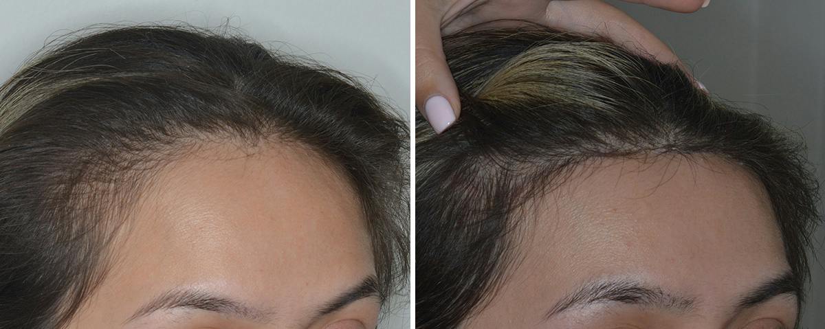 Hair Transplant Before & After Gallery - Patient 816121 - Image 2