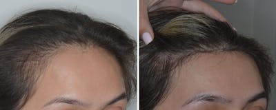 Hair Transplant Before & After Gallery - Patient 816121 - Image 2