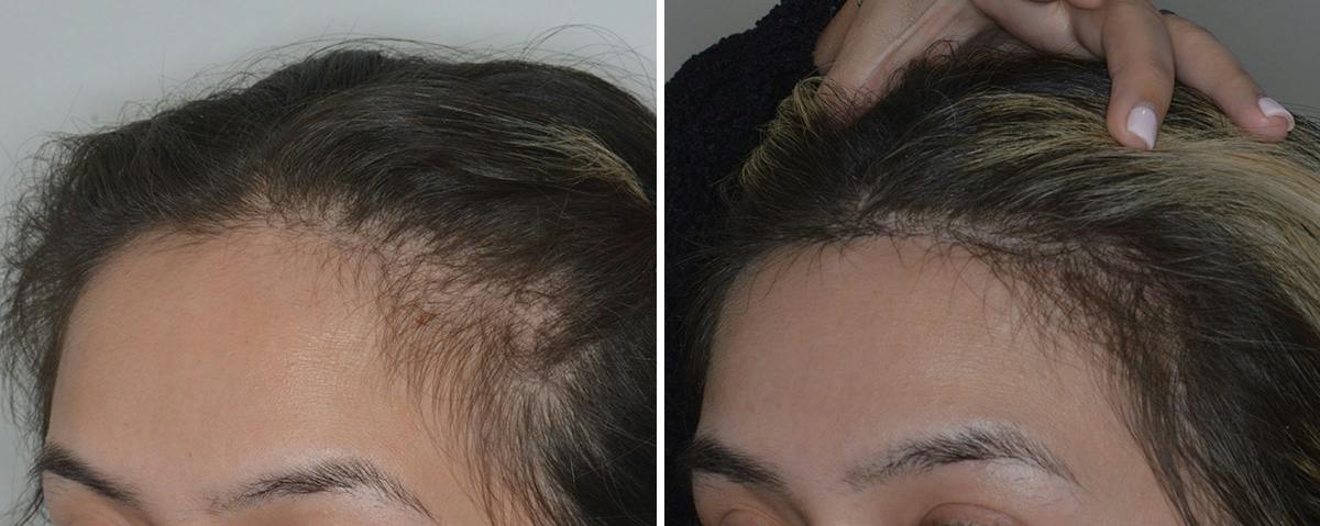 Hair Transplant Before & After Gallery - Patient 816121 - Image 3