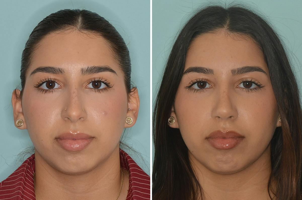Rhinoplasty Before & After Gallery - Patient 164806 - Image 3