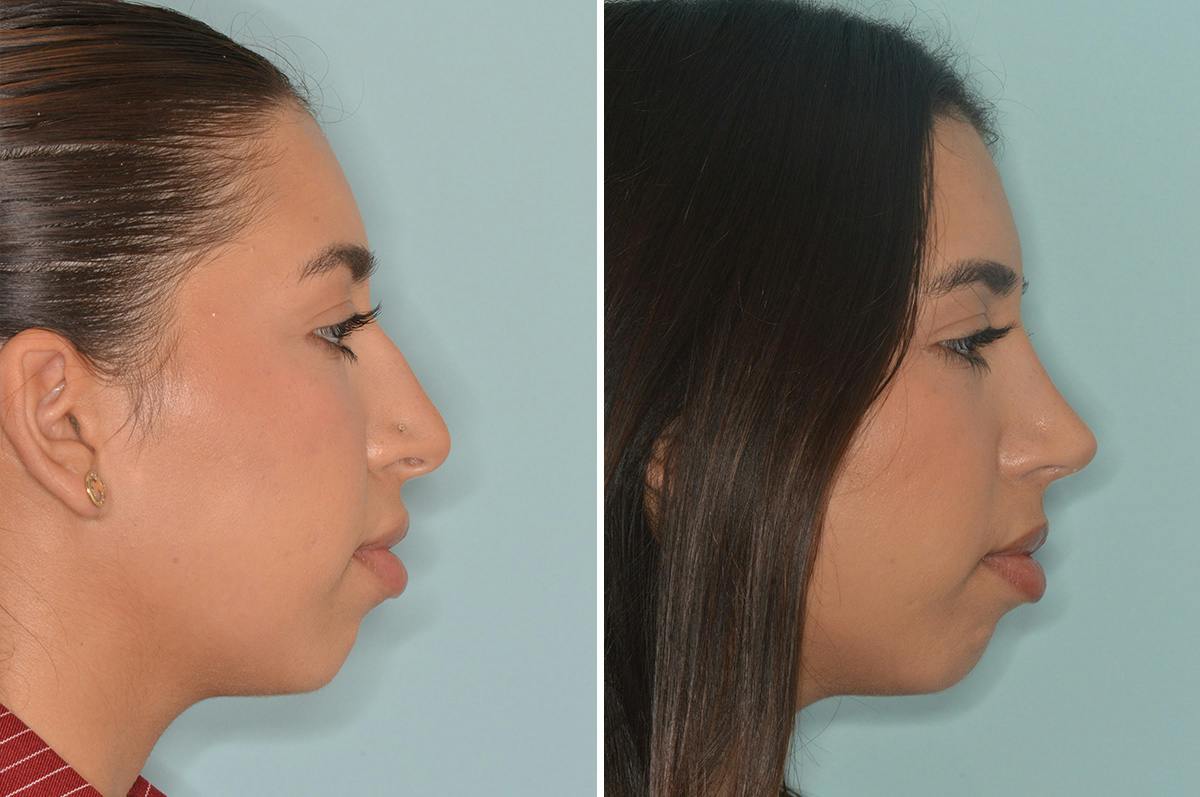 Rhinoplasty Before & After Gallery - Patient 164806 - Image 1