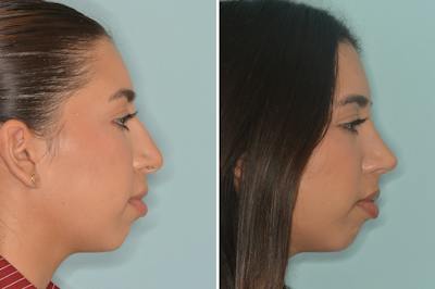 Rhinoplasty Before & After Gallery - Patient 164806 - Image 1