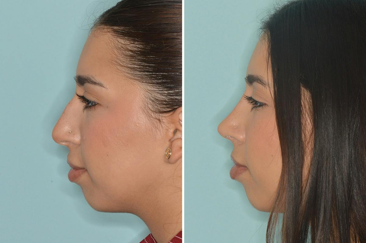 Rhinoplasty Before & After Gallery - Patient 164806 - Image 2