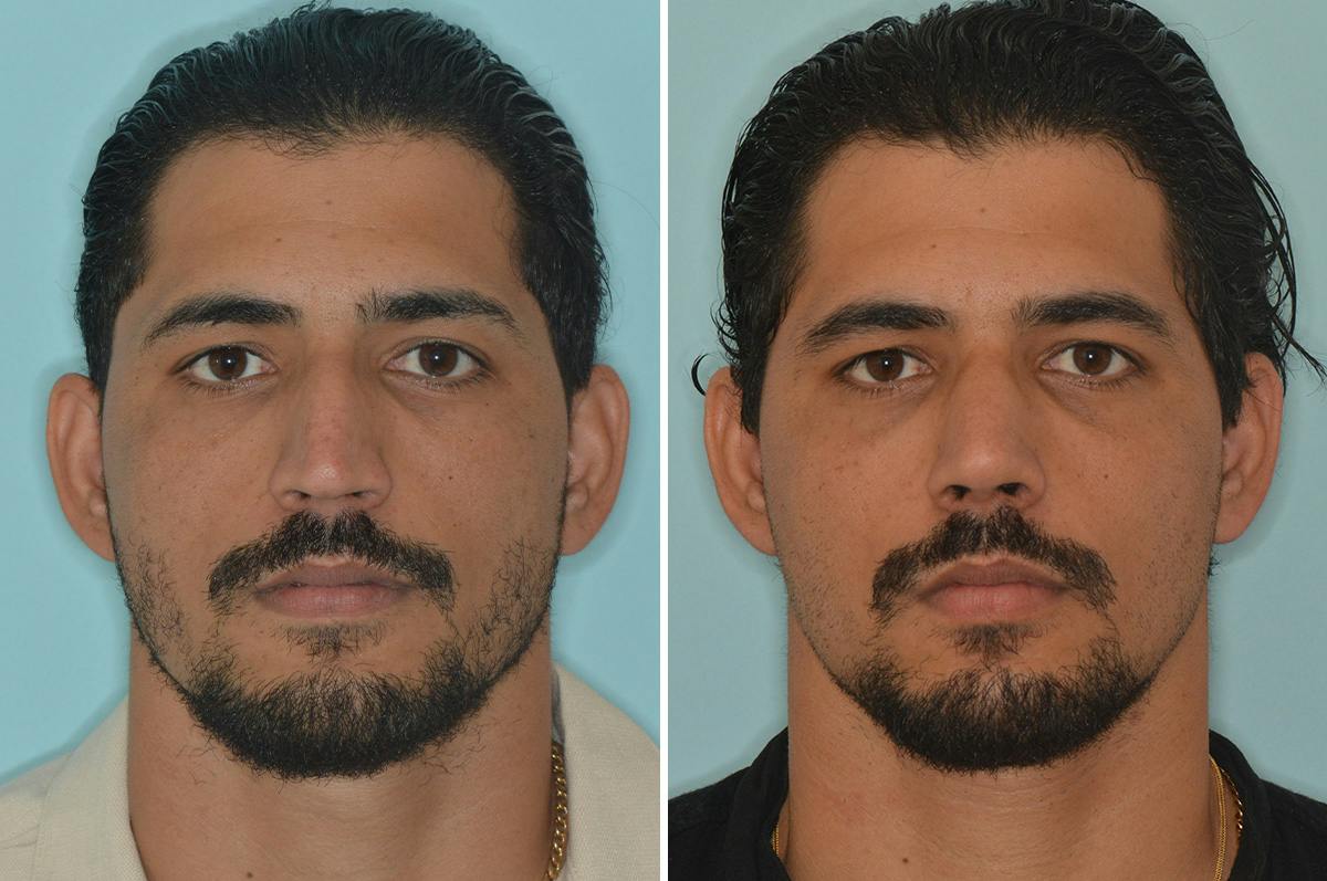 Rhinoplasty Before & After Gallery - Patient 144294 - Image 3