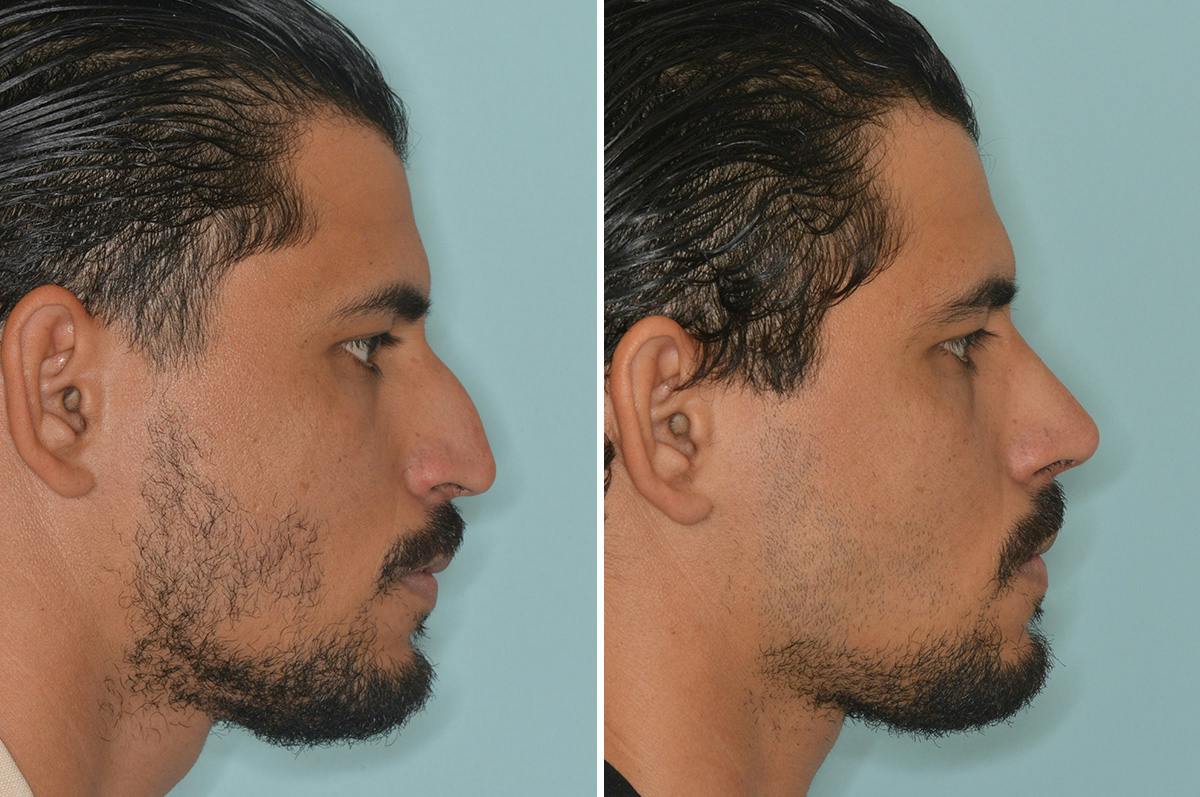 Rhinoplasty Before & After Gallery - Patient 144294 - Image 1