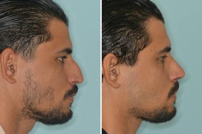 Rhinoplasty Before & After Gallery - Patient 144294 - Image 1