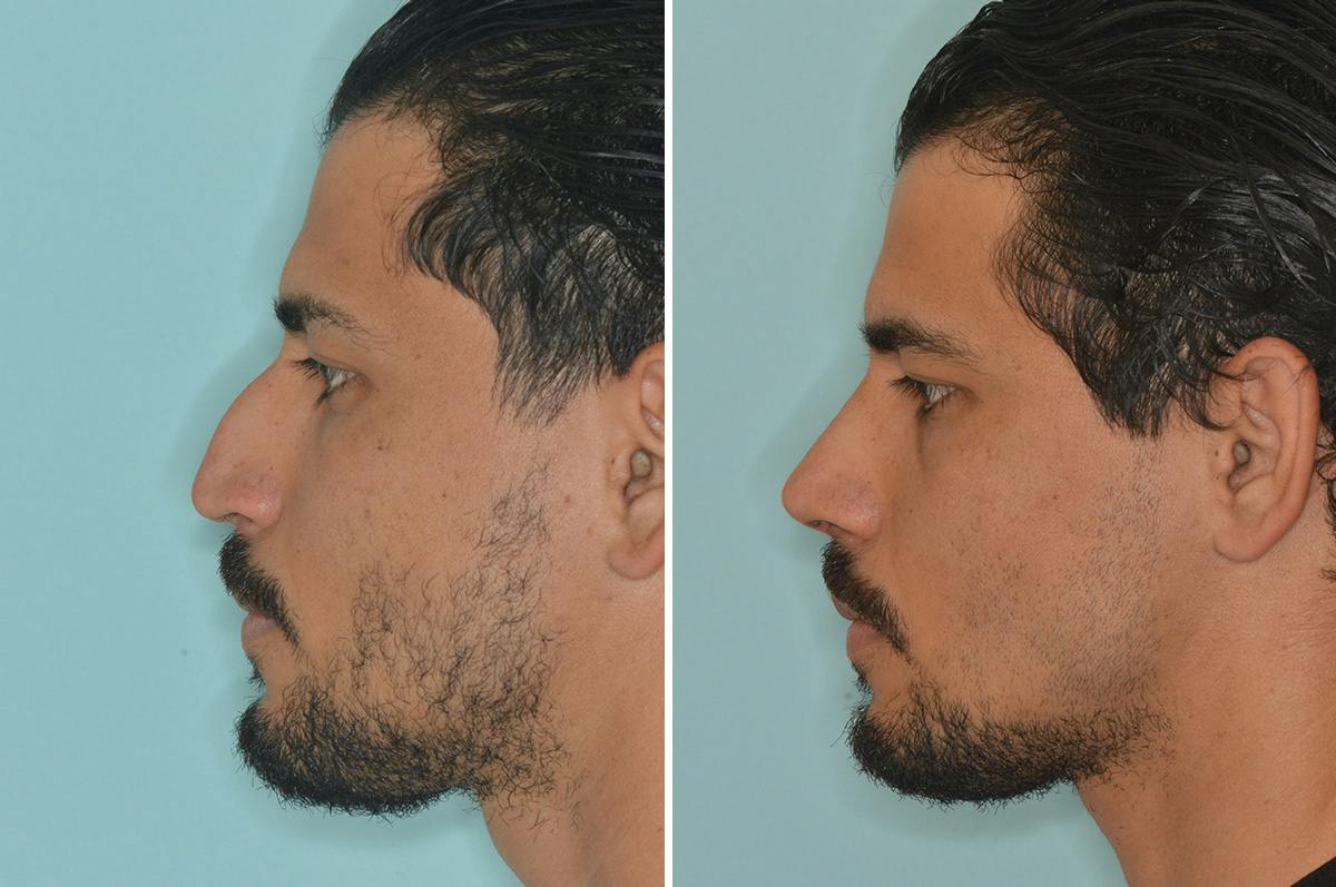 Rhinoplasty Before & After Gallery - Patient 144294 - Image 2
