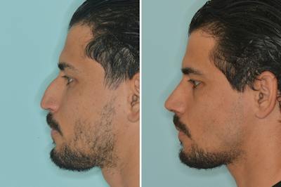 Rhinoplasty Before & After Gallery - Patient 144294 - Image 2