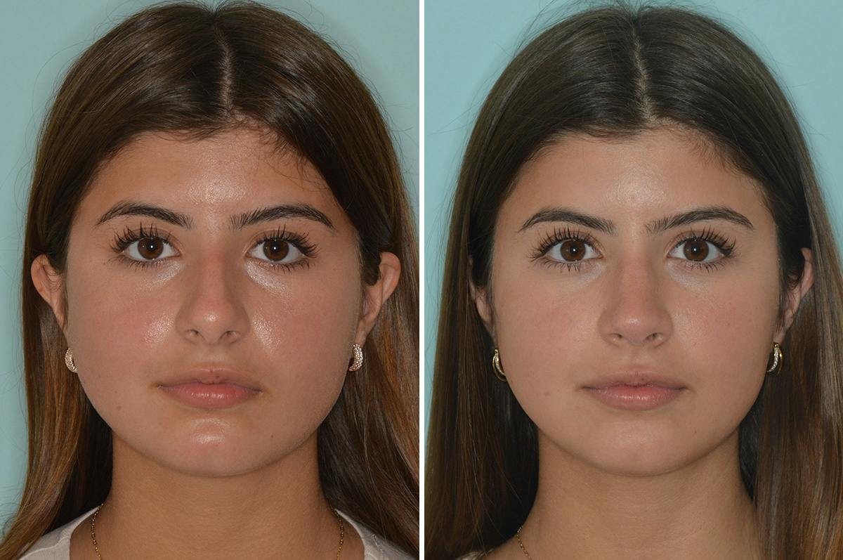 Rhinoplasty Before & After Gallery - Patient 278465 - Image 3