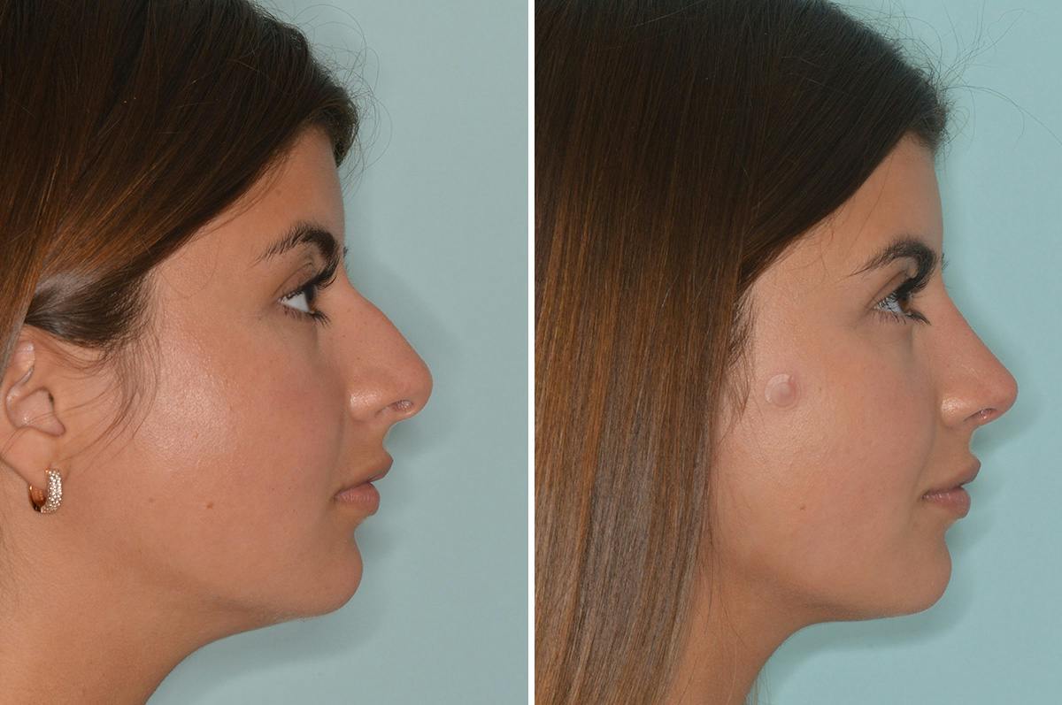 Rhinoplasty Before & After Gallery - Patient 278465 - Image 1