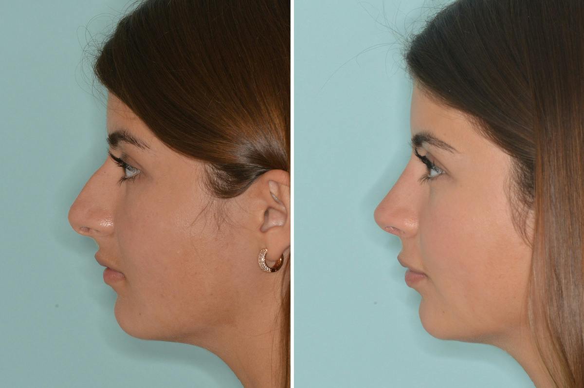 Rhinoplasty Before & After Gallery - Patient 278465 - Image 2