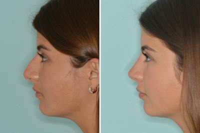 Rhinoplasty Before & After Gallery - Patient 278465 - Image 2