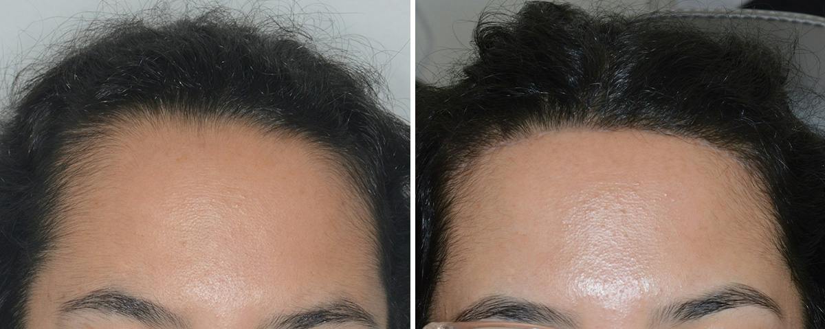 Hair Transplant Before & After Gallery - Patient 112496 - Image 1