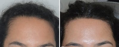 Hair Transplant Before & After Gallery - Patient 112496 - Image 1
