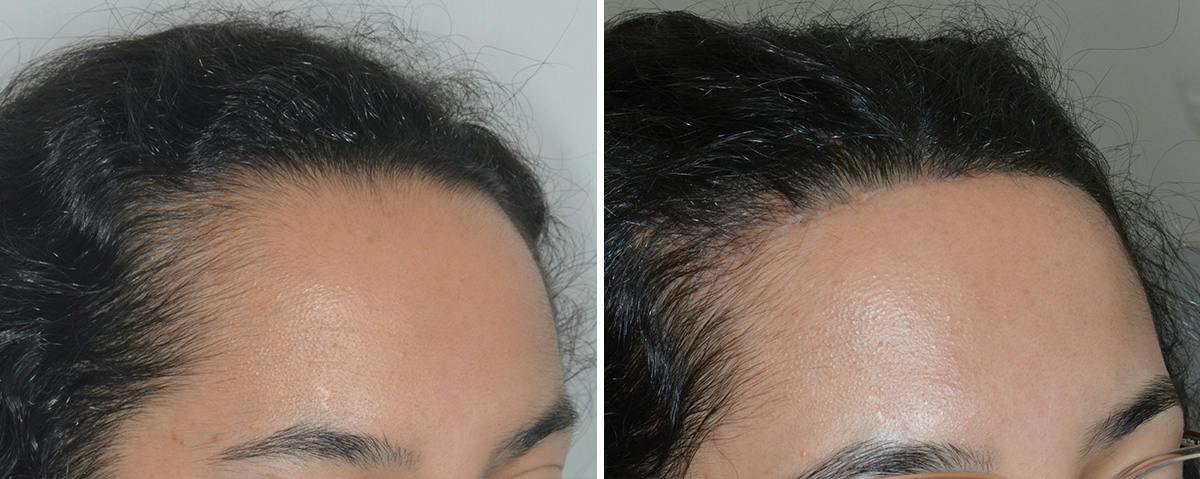 Hair Transplant Before & After Gallery - Patient 112496 - Image 2