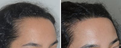 Hair Transplant Before & After Gallery - Patient 112496 - Image 2