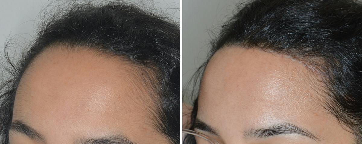 Hair Transplant Before & After Gallery - Patient 112496 - Image 3